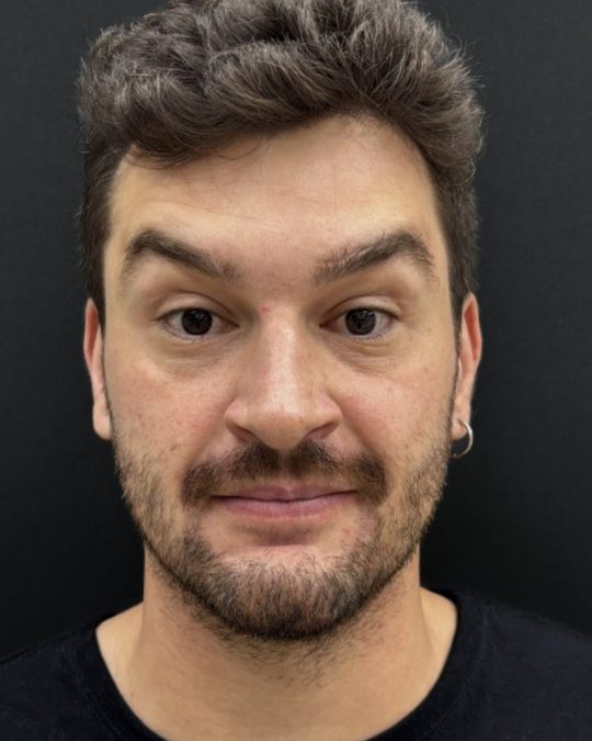 Depois da toxina botulínica